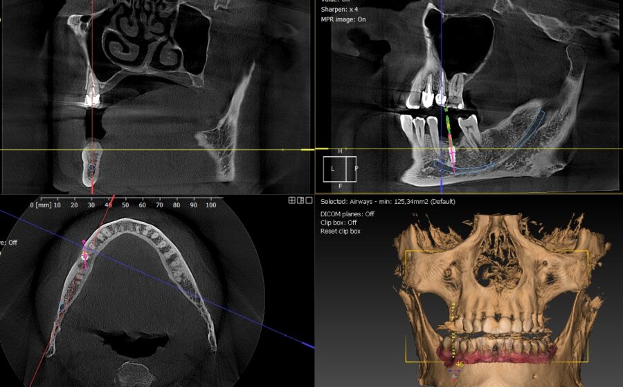 CBCT dentaire : utilité, indications et pathologies au cabinet